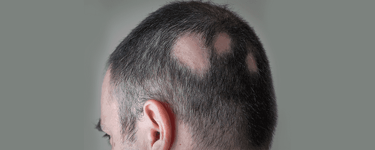 alopecia-what-are-the-causes-and-its-treatment