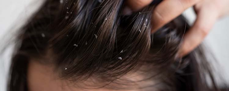 Dandruff in Kids, Causes and Cures