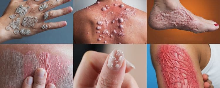 Different Types of Psoriasis and Their Symptoms