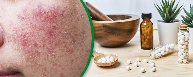 Homeopathy-for-Skin-Rashes--10-Effective-Remedies-to-Try