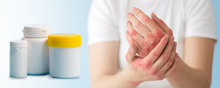 Lichen Planus No More Discover the Benefits of Homeopathy Medicines